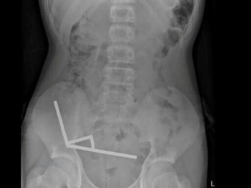 Surgeons remove up to 100 magnets from N. Zealand teen's gut